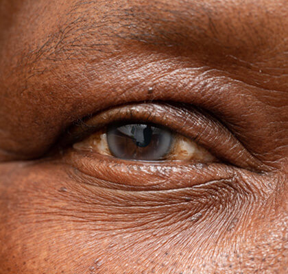 Man with Cataracts